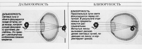 Рассмотрите рисунок сравните близорукость и дальнозоркость ответы занесите в таблицу